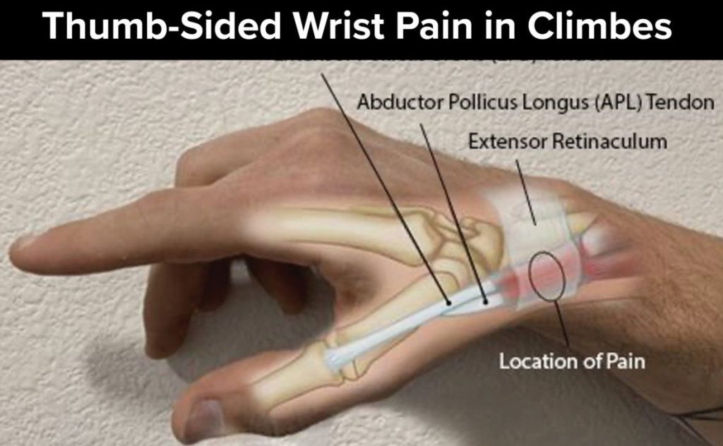 wrist pain